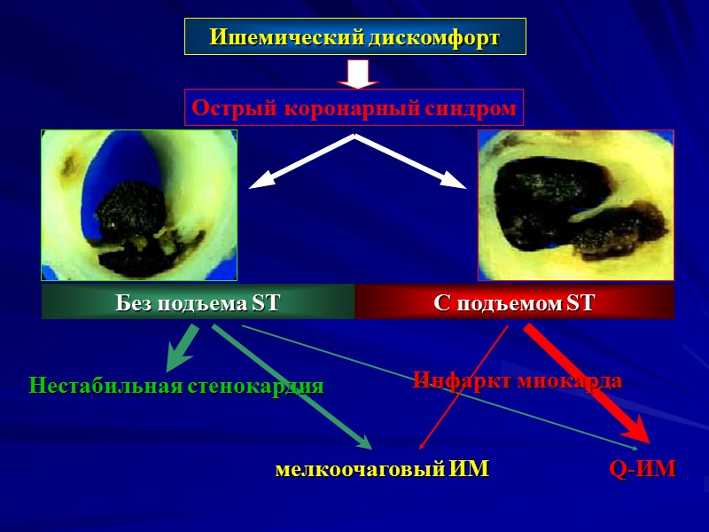 Ишемический дискомфорт Острый коронарный синдром C подъемом ST Без подъема ST мелкоочаговый ИМ Q-ИМ